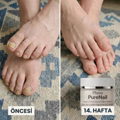 Pheva - PureNail™